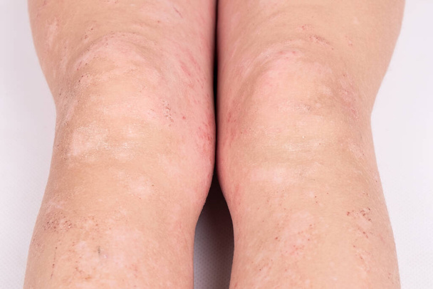 rash on children legs close-up, redness of the skin, allergic reaction - Photo, Image