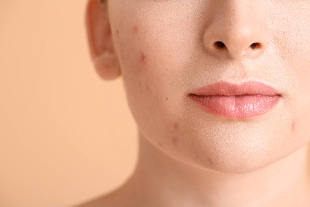 Young woman with acne problem on color background, closeup - Foto, imagen