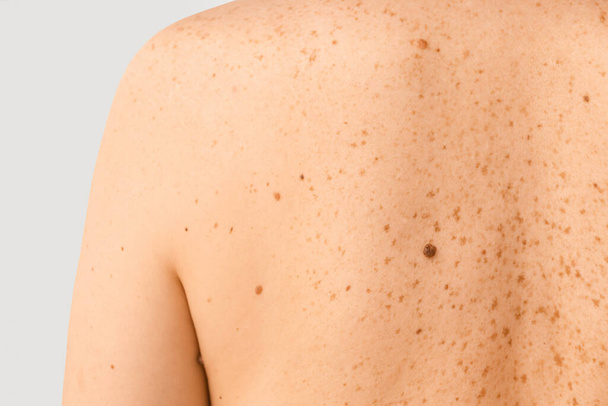 Young woman with moles on her skin, closeup - Foto, Imagem