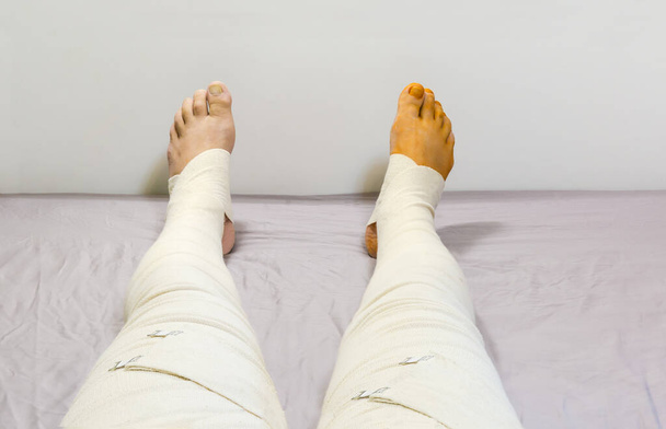 Απλωμένα ανθρώπινα πόδια σφιχτά τυλιγμένα με υφασμένους ελαστικούς ιατρικούς επιδέσμους και στερεωμένα με κλιπ στο κρεβάτι μετά την επέμβαση, επιλεκτική εστίαση - Φωτογραφία, εικόνα