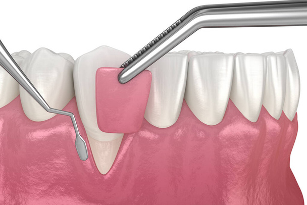 Gum ύφεση: Μαλακό μόσχευμα ιστού χειρουργική επέμβαση. 3D απεικόνιση της οδοντιατρικής θεραπείας - Φωτογραφία, εικόνα