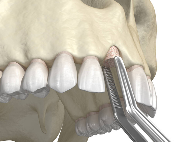 Przeszczepienie kości - powiększenie metodą pierścienia, wszczepienie zęba. Medycznie dokładna ilustracja 3D - Zdjęcie, obraz