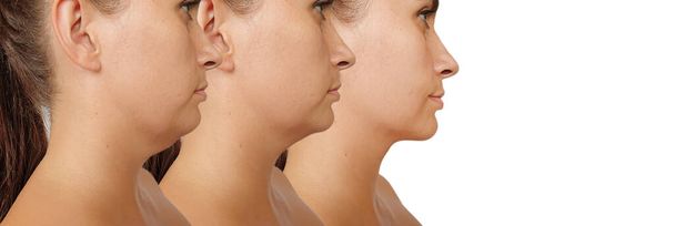 žena dvojitá brada před a po léčbě - Fotografie, Obrázek