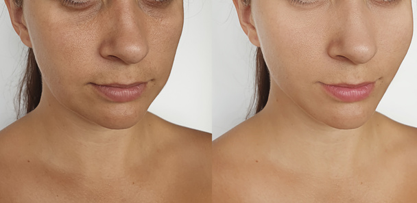 woman face wrinkles before and after treatment collage - Foto, imagen