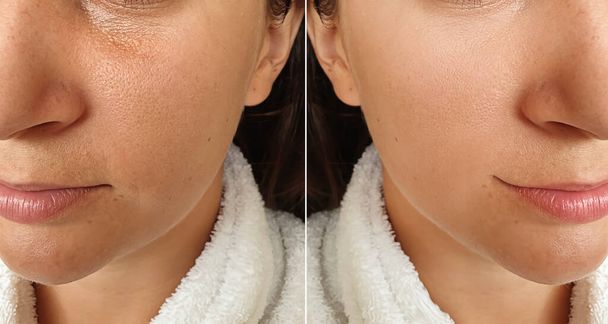 woman face wrinkles before and after treatment collage - Photo, Image