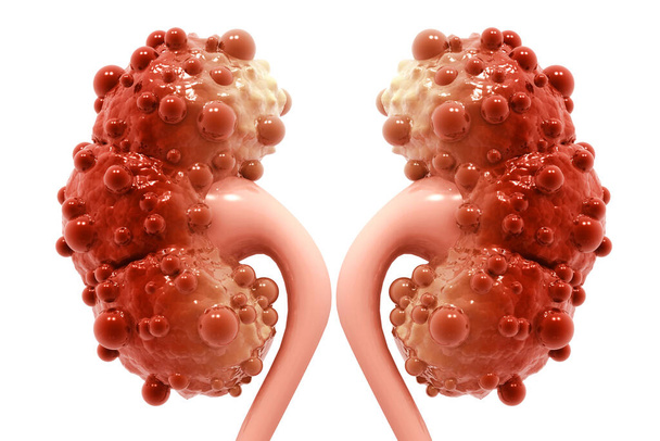 kidney disease on white background - Photo, Image