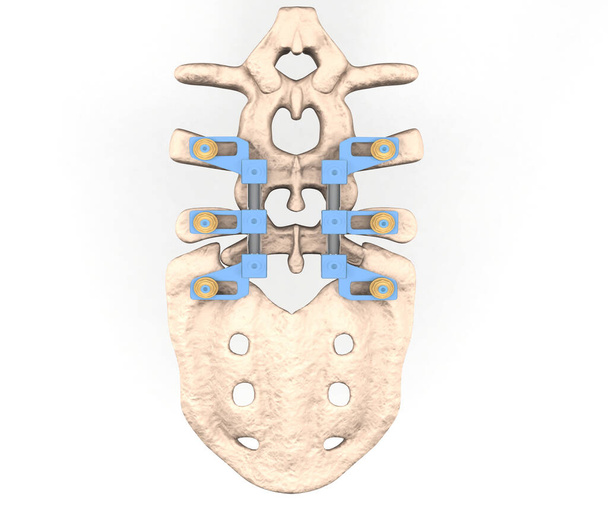 gerincoszlop implantátummal, csavaros elhelyezéssel, 3D illusztráció - Fotó, kép