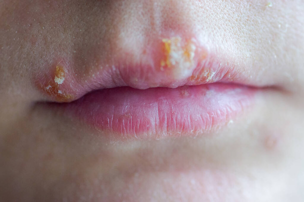 Choroba opryszczki na ustach młodej dziewczyny - Zdjęcie, obraz
