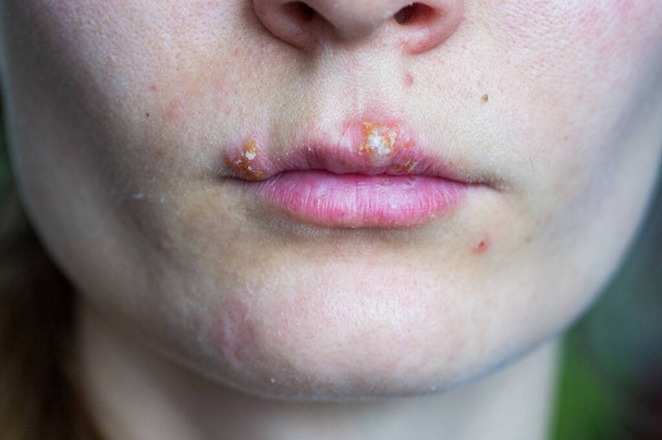Болезнь герпеса на губах молодой девушки - Фото, изображение