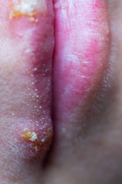 若い女の子の唇にヘルペス疾患 - 写真・画像