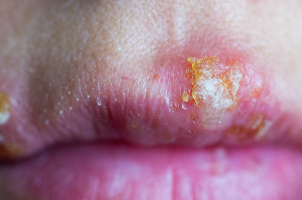 Хвороба герпесу на губах молодої дівчини
 - Фото, зображення