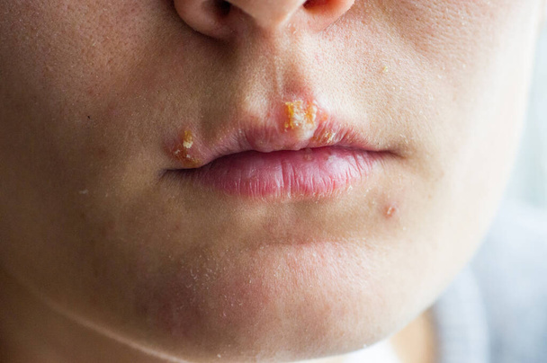 Ασθένεια του έρπη στα χείλη ενός νεαρού κοριτσιού - Φωτογραφία, εικόνα