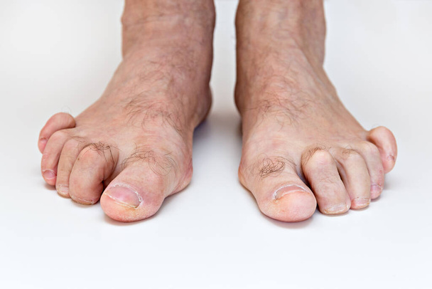 Çekiç ayak, bükülmüş ayak parmakları, anomali, hastalık. - Fotoğraf, Görsel