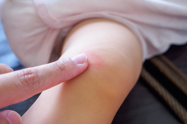 matka nanáší antialergický krém na dětské koleno s kožní vyrážkou a alergií s červenou skvrnou příčina komáří kousnutí - Fotografie, Obrázek