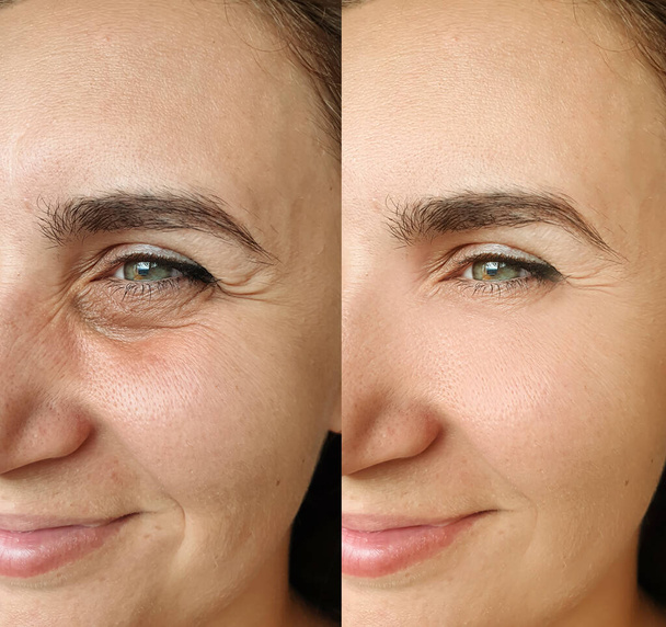 vrouw gezicht rimpels voor en na behandeling collage - Foto, afbeelding