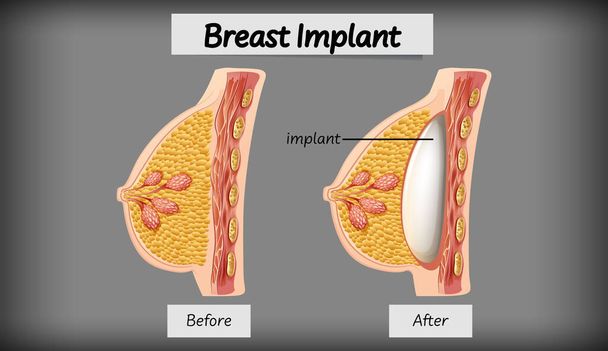 Premium Vector  Types of breast vector illustration breast anatomy
