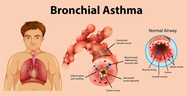 Illustration du tube bronchique enflammé par l'asthme - Vecteur, image