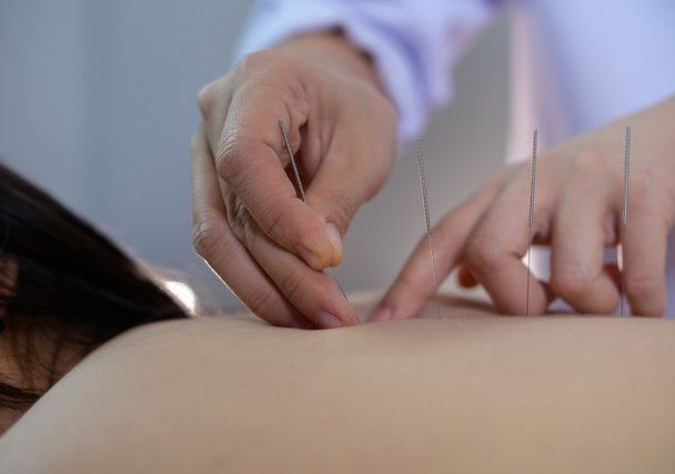 close-up Jovem do sexo feminino recebendo tratamento de acupuntura - Foto, Imagem