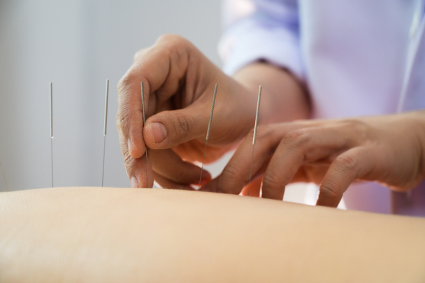 primer plano Mujer joven recibiendo tratamiento de acupuntura - Foto, imagen