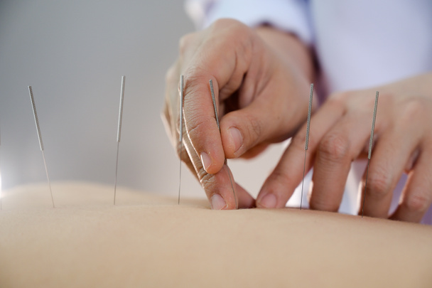 close-up Jovem do sexo feminino recebendo tratamento de acupuntura - Foto, Imagem
