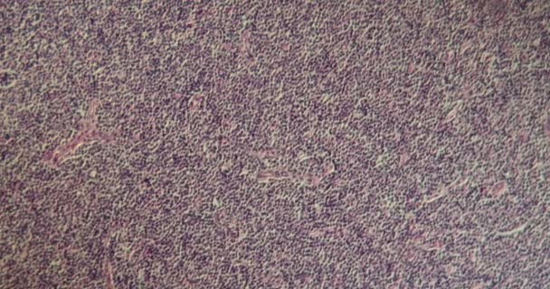 linfoma maligno tecido doente em alta ampliação ao microscópio 100x - Filmagem, Vídeo