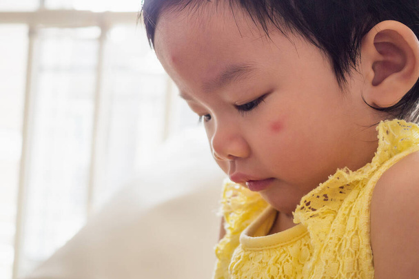 Alerjisi olan küçük tatlı Asyalı kız. Böcek ısırığından dolayı yüzü kızardı. - Fotoğraf, Görsel