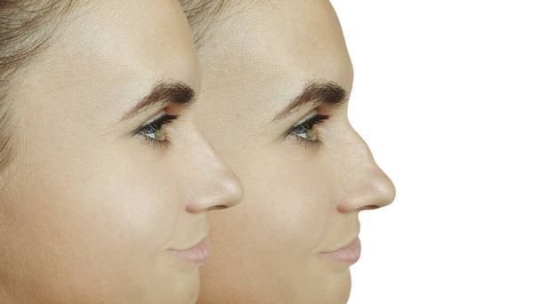 白地に鼻形成術前後の若い女性 - 写真・画像