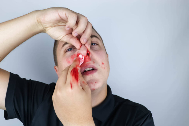 El hombre tiene la nariz rota después de una pelea. Sangre en las manos, mejillas y nariz. Las consecuencias de la conducta agresiva en los hombres. Los intentos de detener el sangrado resultaron en manchas de sangre en toda la cara.. - Foto, imagen