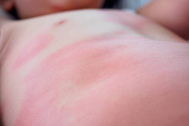 Súlyos ekcéma bőrkiütés és allergiás reakció tünetei kis ázsiai gyermek testen túlérzékenység miatt - Fotó, kép