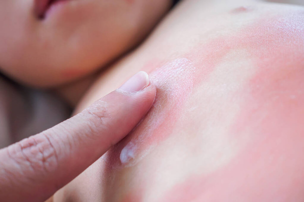Doctor hand applying topical antihistamine medicine cream on little girl body with severe skin rash and allergy - Photo, Image
