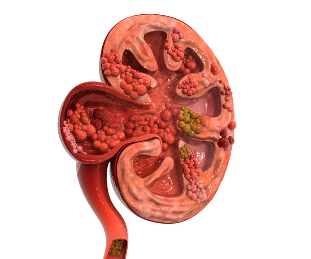 kidney disease. Cross section - Photo, Image