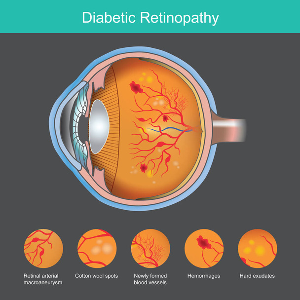 Диабетическая ретинопатия. Иллюстрация аномалии сетчатки от симптомов диабетической ретинопатии - Вектор,изображение