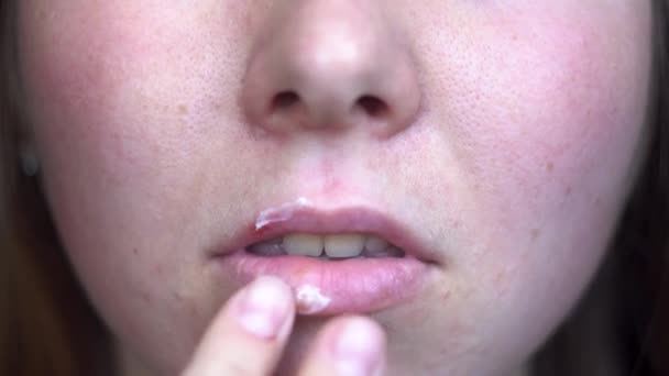 Egy fiatal nő, aki herpesztől szenved az ajkain. A média. Az ajkakra kenőcsöt felhordó női ujjak közelsége, herpeszfertőzés és vírus kezelése. - Felvétel, videó
