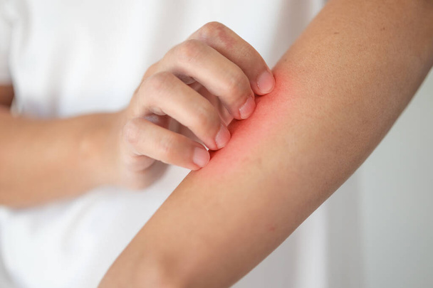 Mann juckt und kratzt am Arm von juckenden trockenen Hautekzemen Dermatitis - Foto, Bild