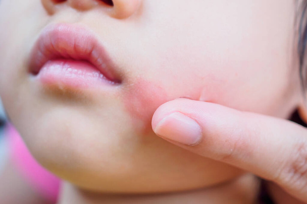 mère appliquant de la crème antihistaminique topique sur le visage de l'enfant avec une éruption cutanée et une allergie avec une tache rouge causée par une piqûre de moustique - Photo, image