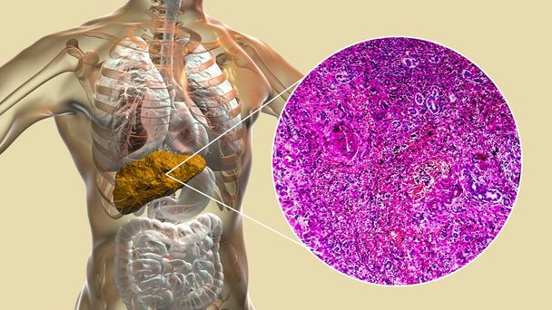 Játra s cirhózou uvnitř lidského těla. 3D ilustrace a světelný mikrograf portálové cirhózy - Fotografie, Obrázek