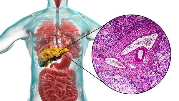Печінка з цирозом всередині людського тіла. 3D ілюстрація та легкий мікрограф портального цирозу
 - Фото, зображення