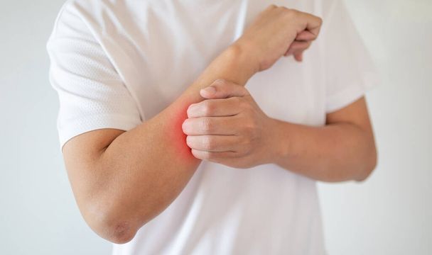 man itching and scratching on arm from itchy dry skin eczema dermatitis - Foto, Imagem