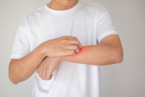 чоловічий свербіж і подряпини на руці від сверблячки сухої шкіри екземи дерматиту
 - Фото, зображення