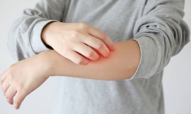 Молодая азиатская женщина зудит и царапает руку от зудящего сухого дерматита кожи экземы - Фото, изображение