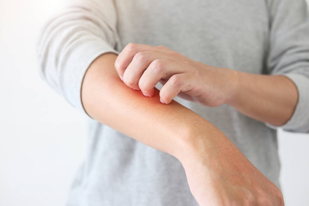 Jeune homme asiatique démangeaisons et éraflures sur le bras de démangeaisons peau sèche eczéma dermatite - Photo, image