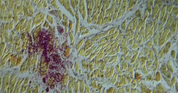 Coeur infecté par le champignon Candida après le sida à fort grossissement 100x au microscope - Séquence, vidéo