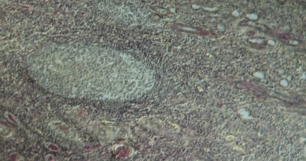 Hydronéphrose tissu malade à fort grossissement au microscope 100x - Séquence, vidéo