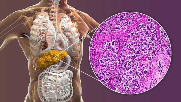 Játra s cirhózou uvnitř lidského těla. 3D ilustrace a světelný mikrograf biliární cirhózy - Fotografie, Obrázek