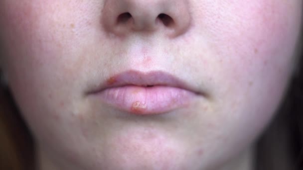 Herpesz vírussal fertőzött női ajkak közelsége. A média. Fogalma orvostudomány és immunológia, boldogtalan női arc piros foltok az ajkain. - Felvétel, videó