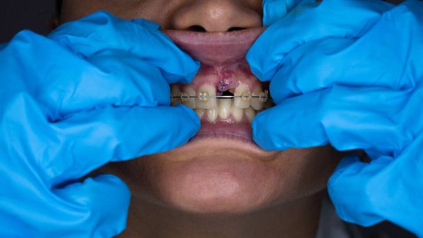 Herida suturada en la boca después de la colocación del implante. Cirugía de implantes dentales. - Foto, imagen