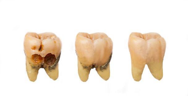 Zahncharakter zeigt Stadien der Kariesentwicklung. Zahnpflegekonzept, isoliert auf weißem Hintergrund. - Foto, Bild