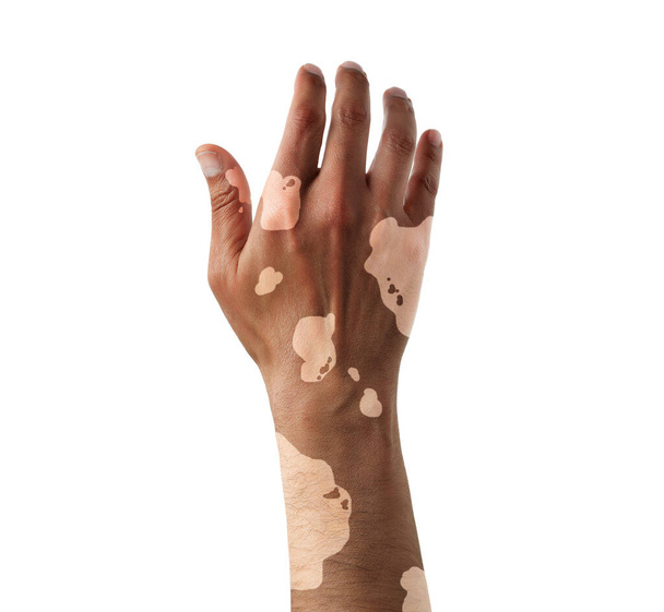 Vitiligo on the hand with white background - Foto, Bild