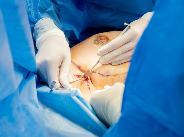 Cirugía para extirpar la mama y reemplazarla con un implante. - Foto, Imagen
