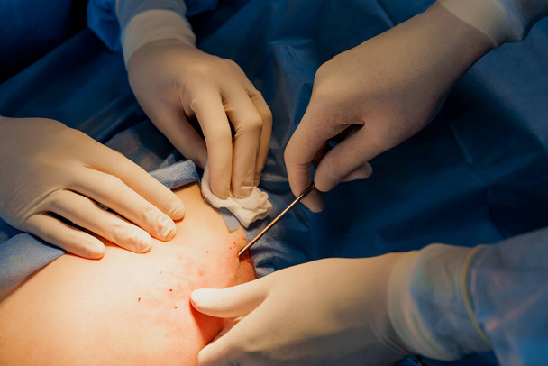 Liposucción para cirugía de lipofilling. foto de cerca de 2 cirujano hacer cirugía plástica llamada blefaroplastia en la clínica médica. - Foto, imagen